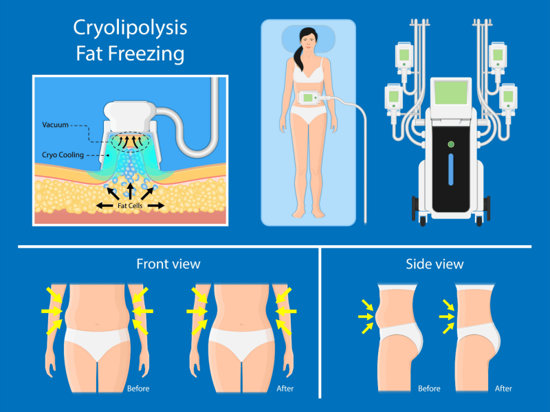 What-Is-Fat-Freezing-Treatment