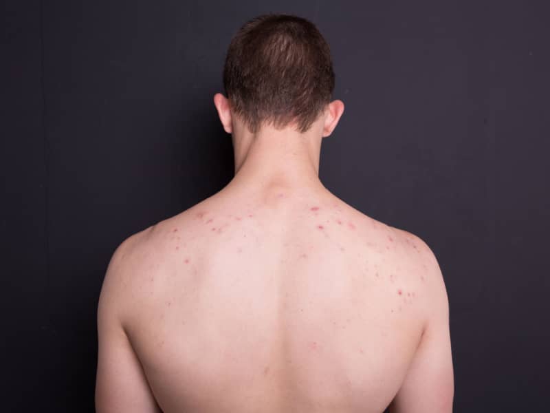 Shocking Truths About Male Back Acne