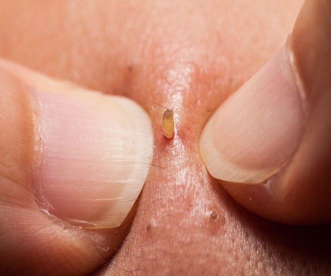 Blackheads — Do’s and Don’ts