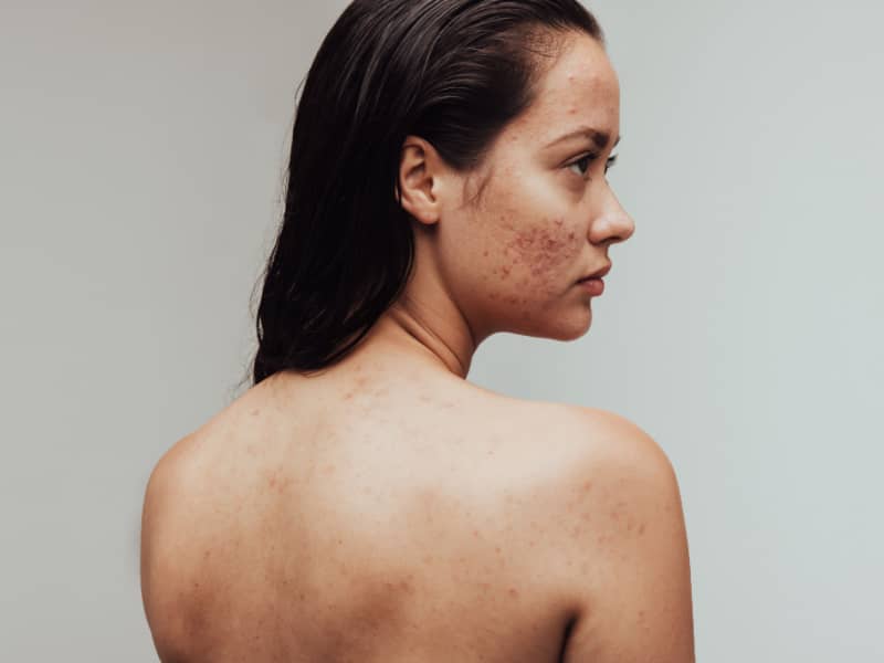 Acne SOS: Tackling Facial, Chest, and Back Acne Head-On