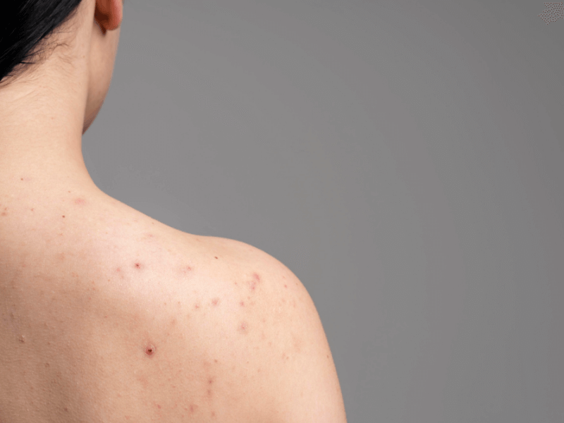 The Realities of Body Acne