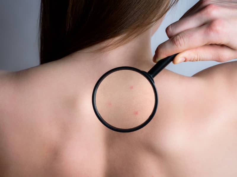 Confront The Acne On Your Back (Backne)