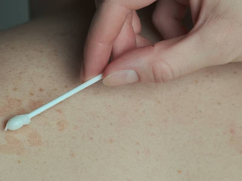 Get-Rid-of-Back-Acne