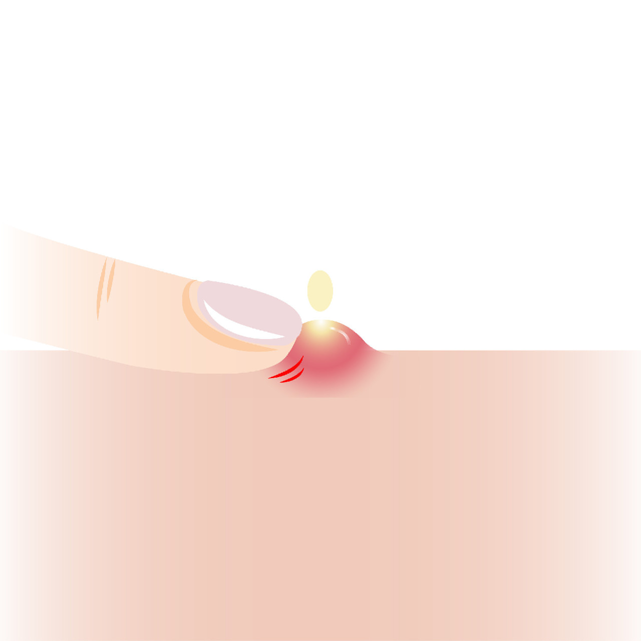 How to Remove Acne Scars in Singapore