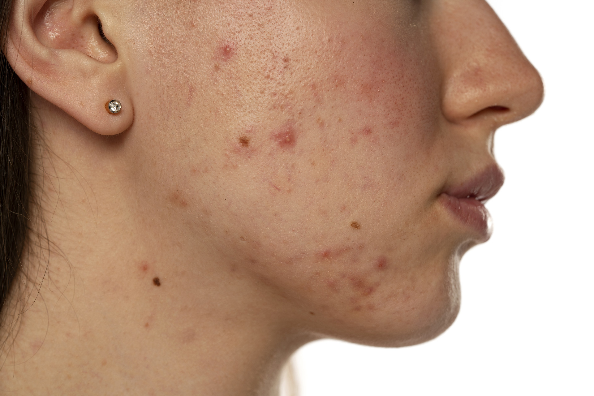 How to Get Rid of Acne Spots in Singapore