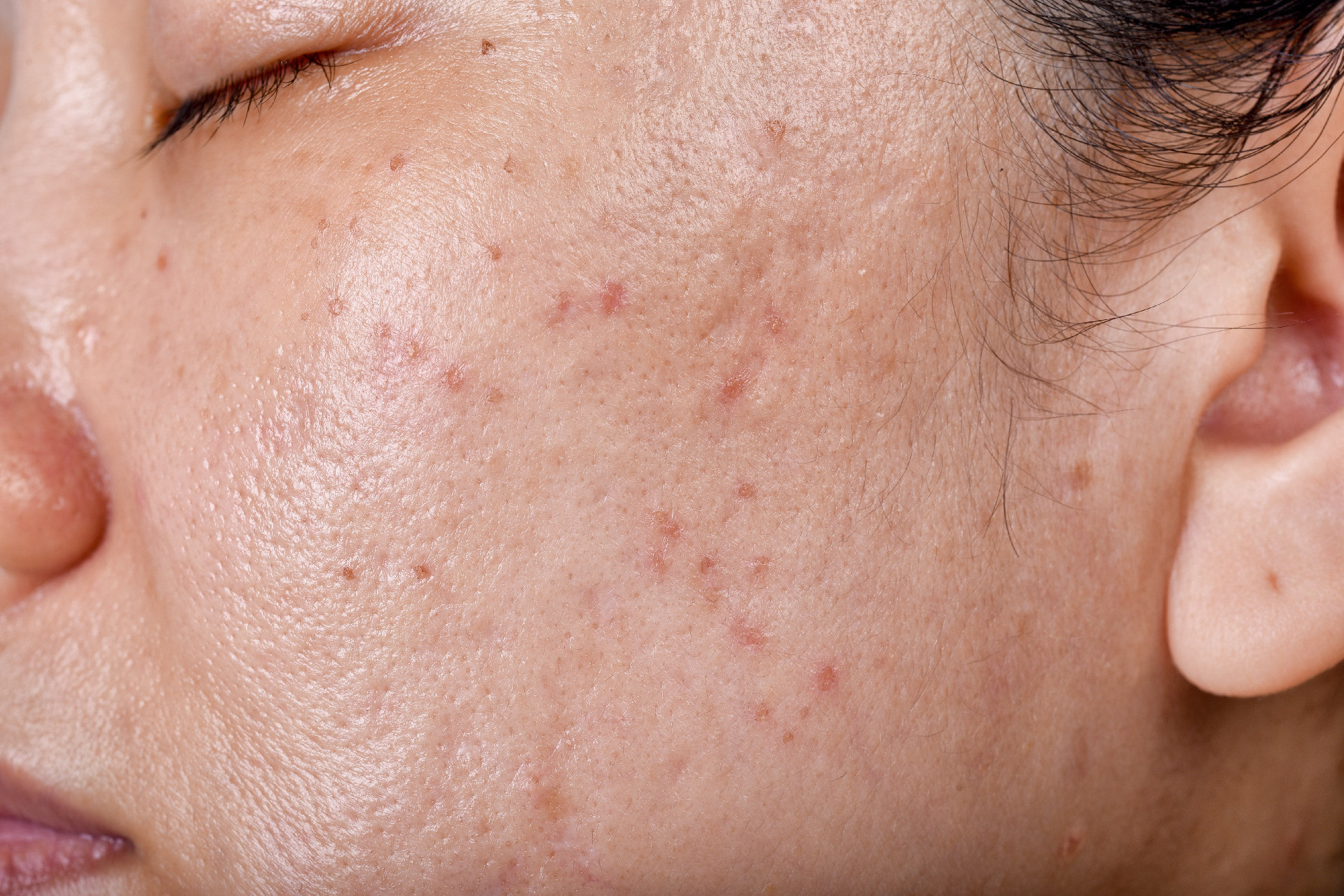 Best Face Scar Removal in Singapore That Works