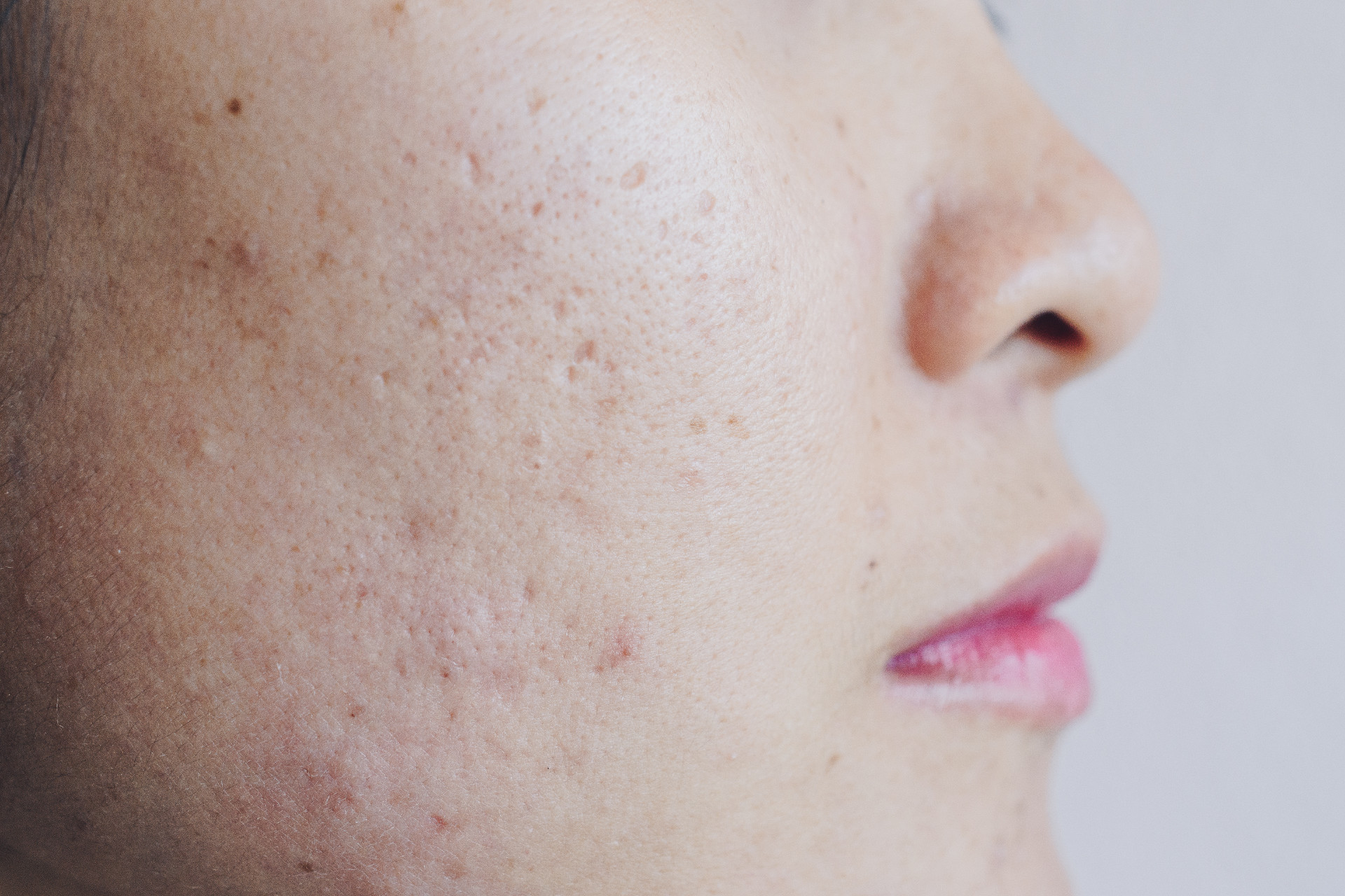How to Start Treating Acne Scars and Hyperpigmentation