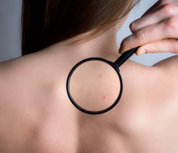 Confront The Acne On Your Back