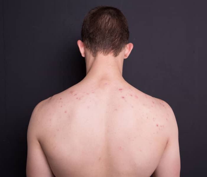 Shocking Truths About Male Backne