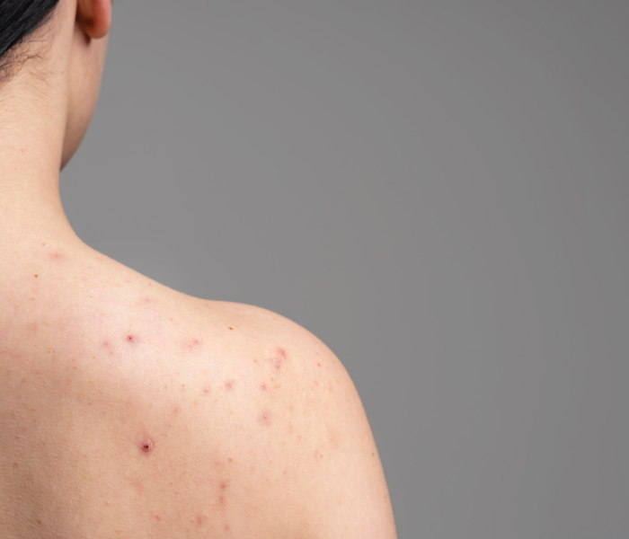 Realities of Body acne